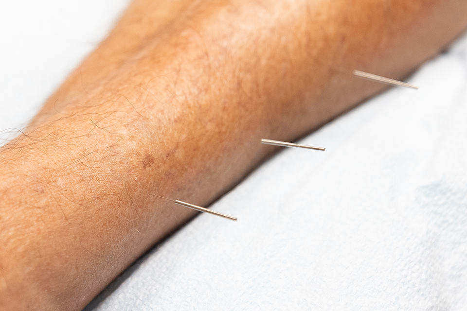 acupuncture needles in arm