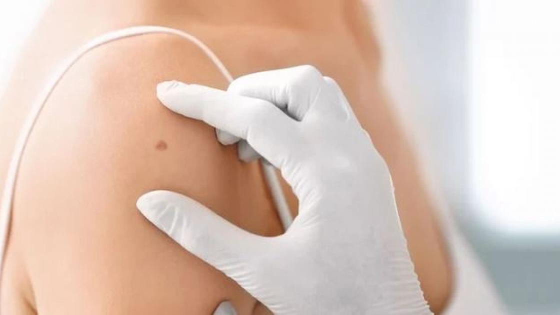 Copy of Mole on Shoulder